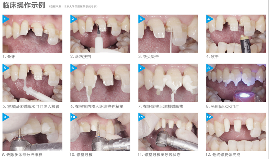 生物医用材料-牙科根管修复成套耗材